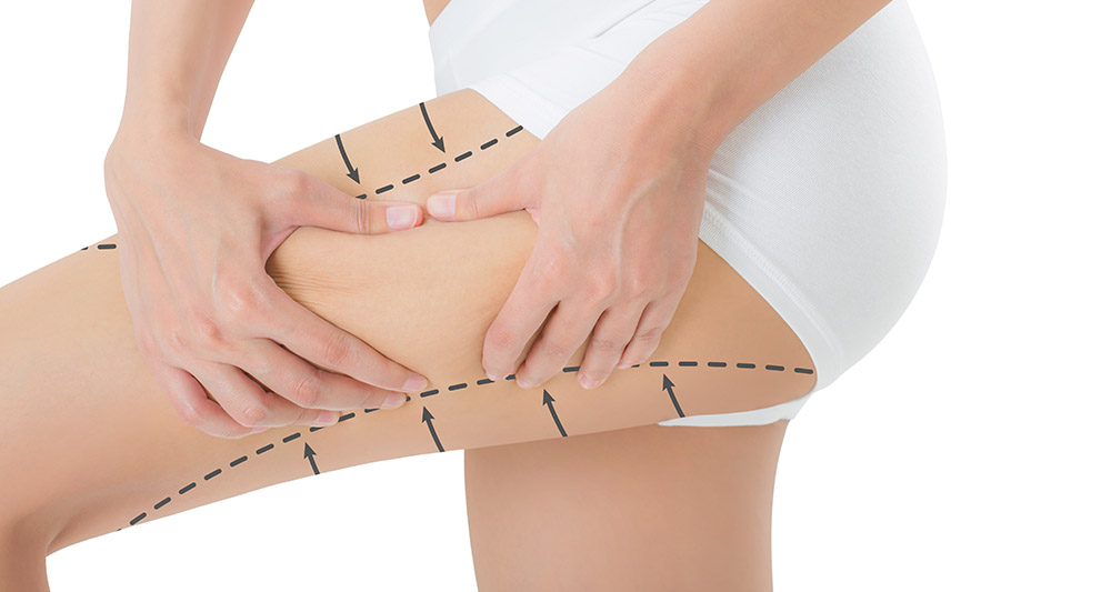 رفع سلولیت با Shockwave