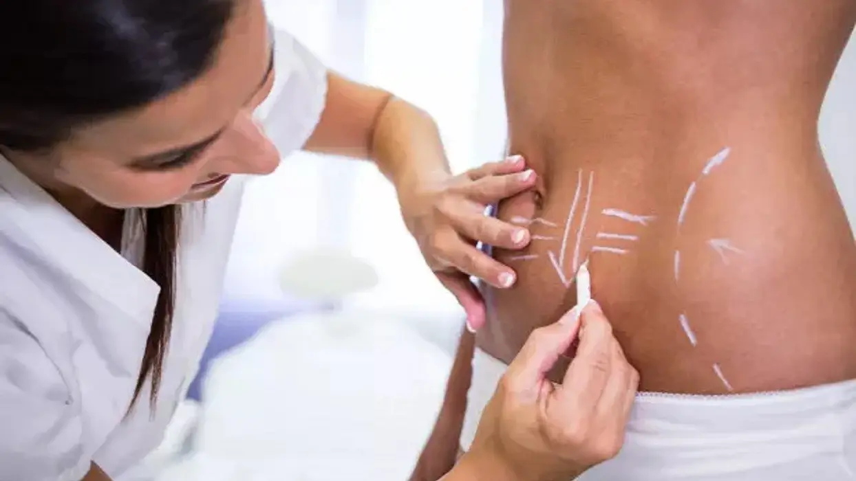 جراحی لیپوماتیک